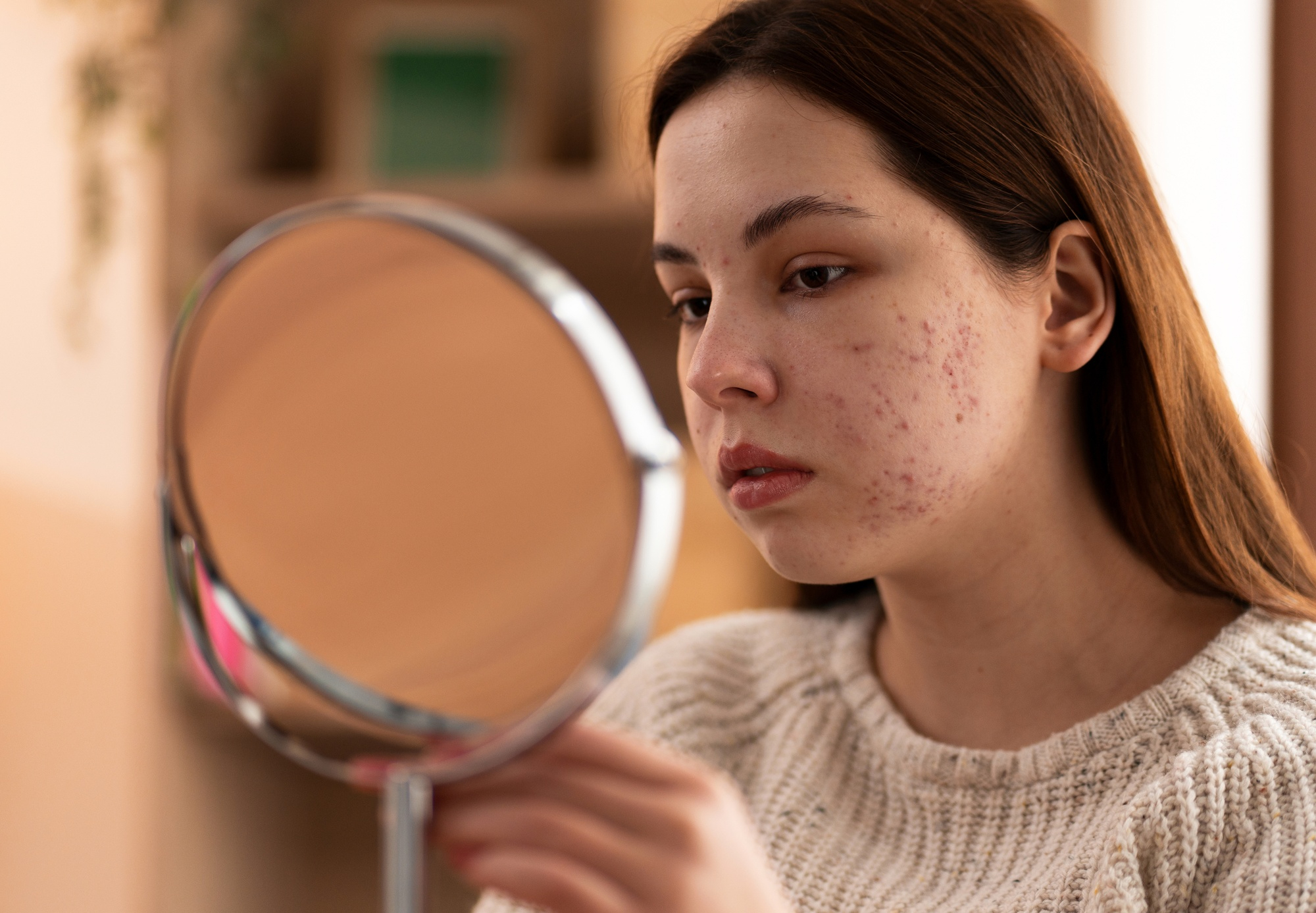 Acne na adolescência: 10 mitos e verdades sobre a condição