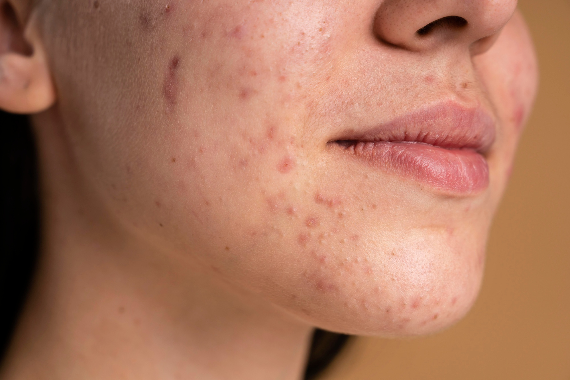 Acne: o que é, sintomas, causas e tratamento 