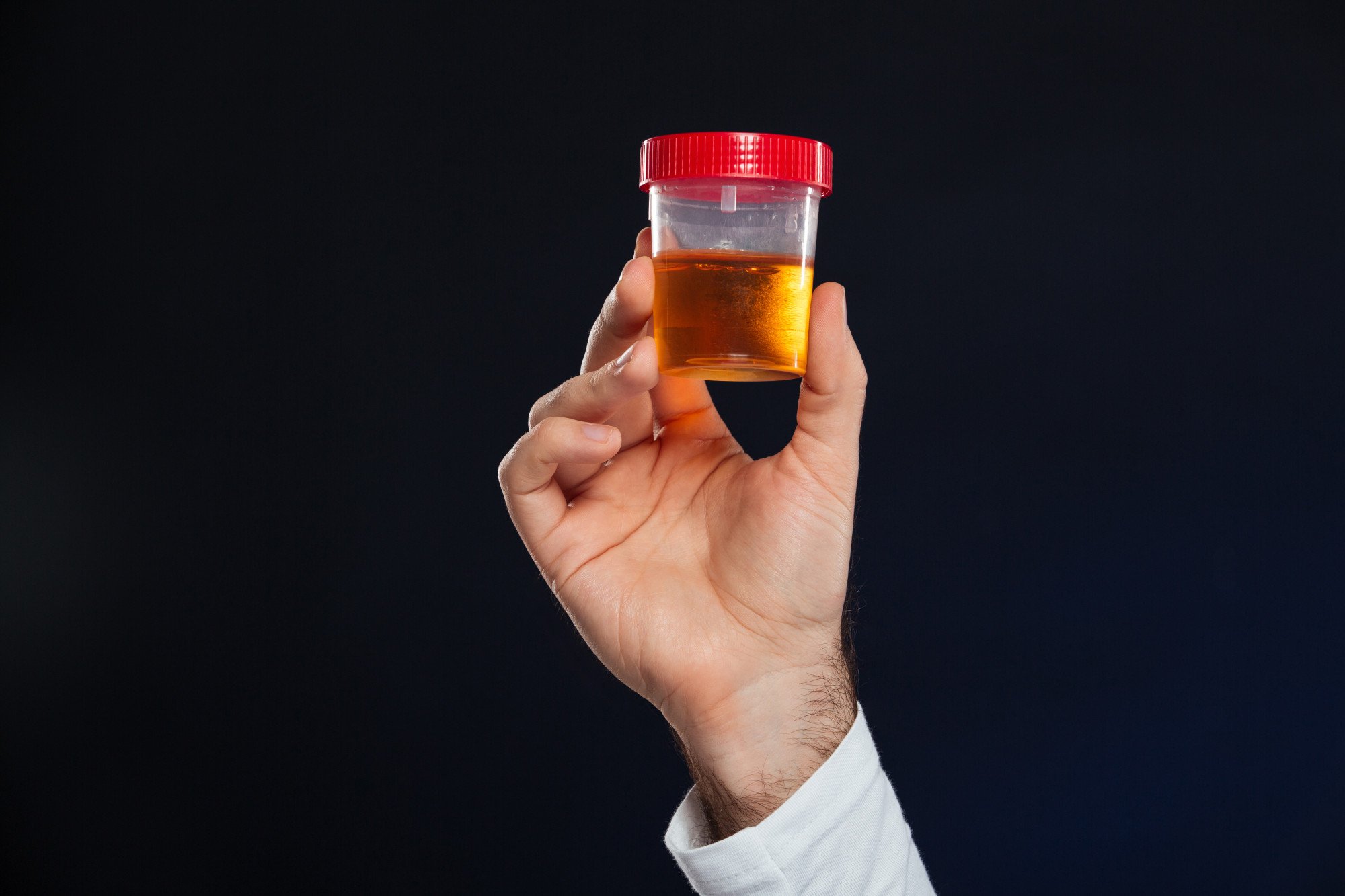 Médico de jaleco branco segura amostra de urina de paciente com infecção urinária.