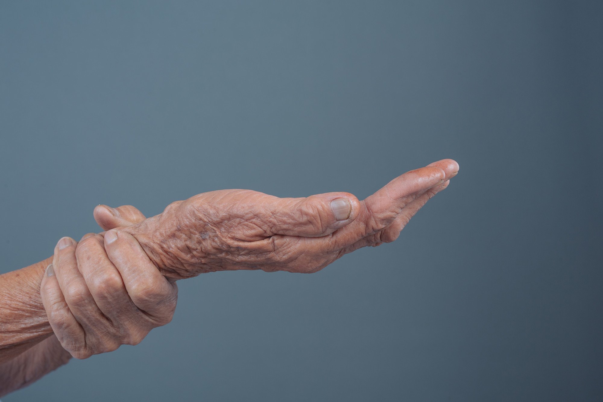 Mão de pessoa idosa com osteoporose