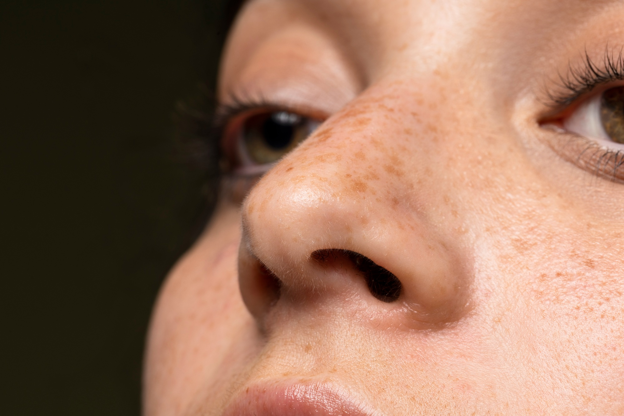 close-up do rosto de uma pessoa mostrando manchas leves de melasma no nariz e bochechas, ilustrando alterações de pigmentação da pele como o melasma.